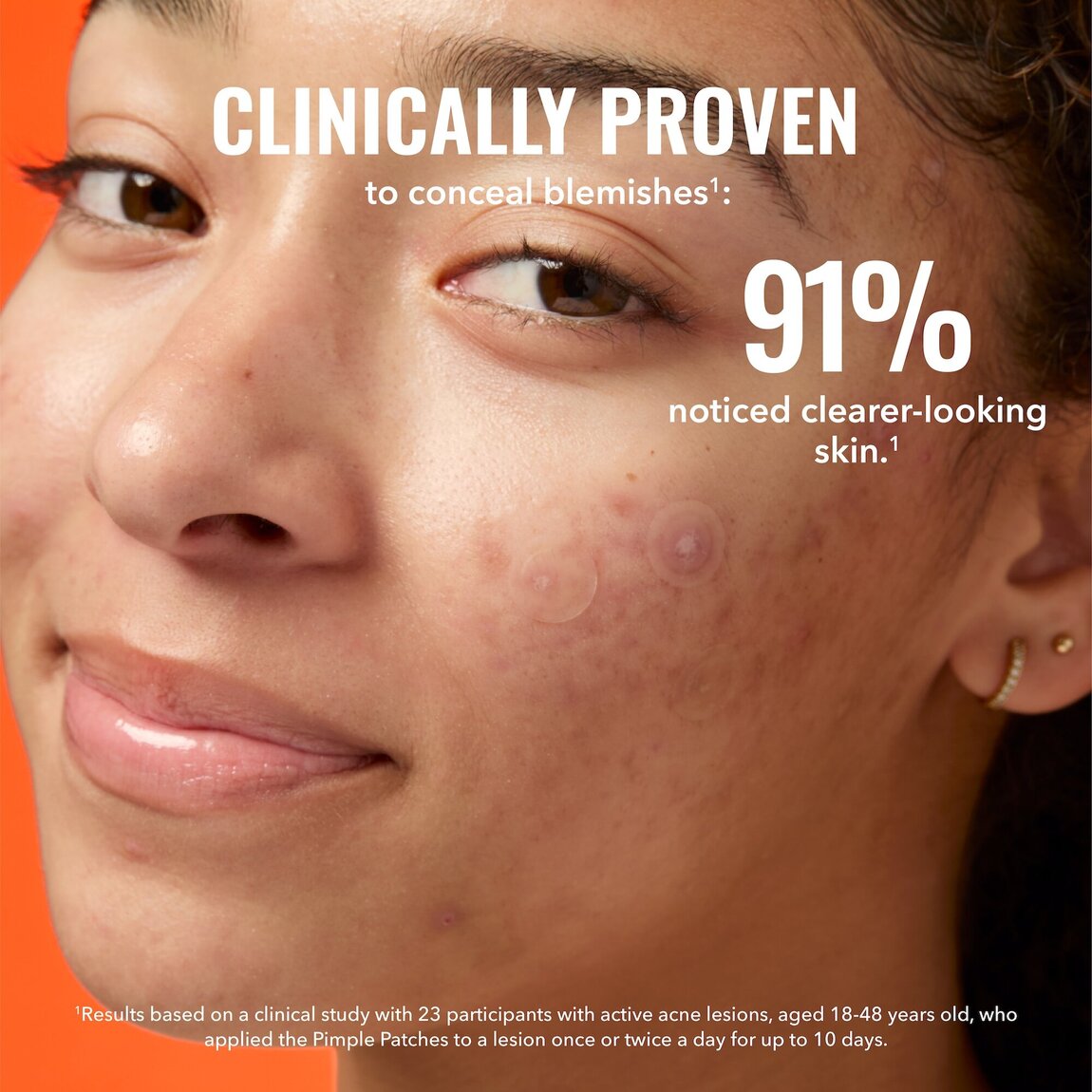 pimple-patches-n5 zb_p.jpg